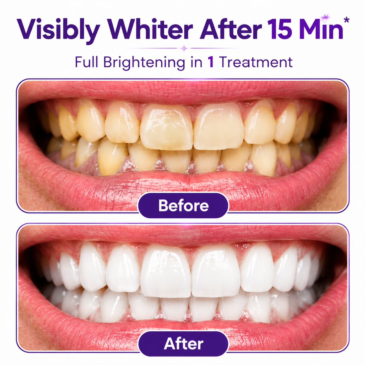 ✅ Formixx Pro Teeth Whitening Strips | Instant Whitening in 15 Minutes