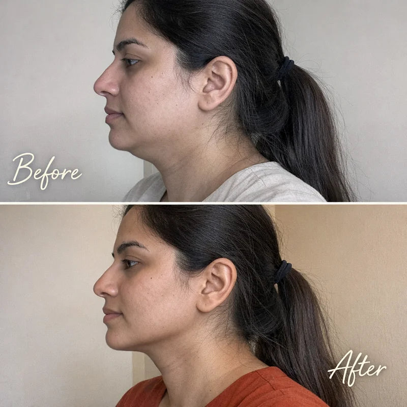 Before and after — Pakistani woman defined jawline after Formixx